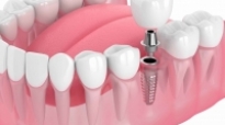 Affordable Dental Implants Near Me